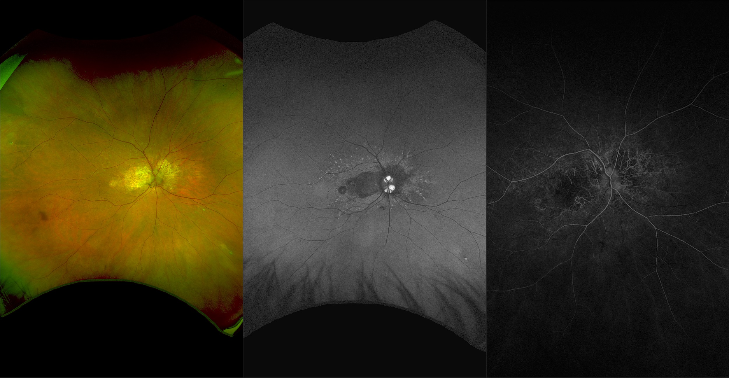 California - Angioid Streaks with Macular Druen and Peripheral Drusen, RG, AF, FA