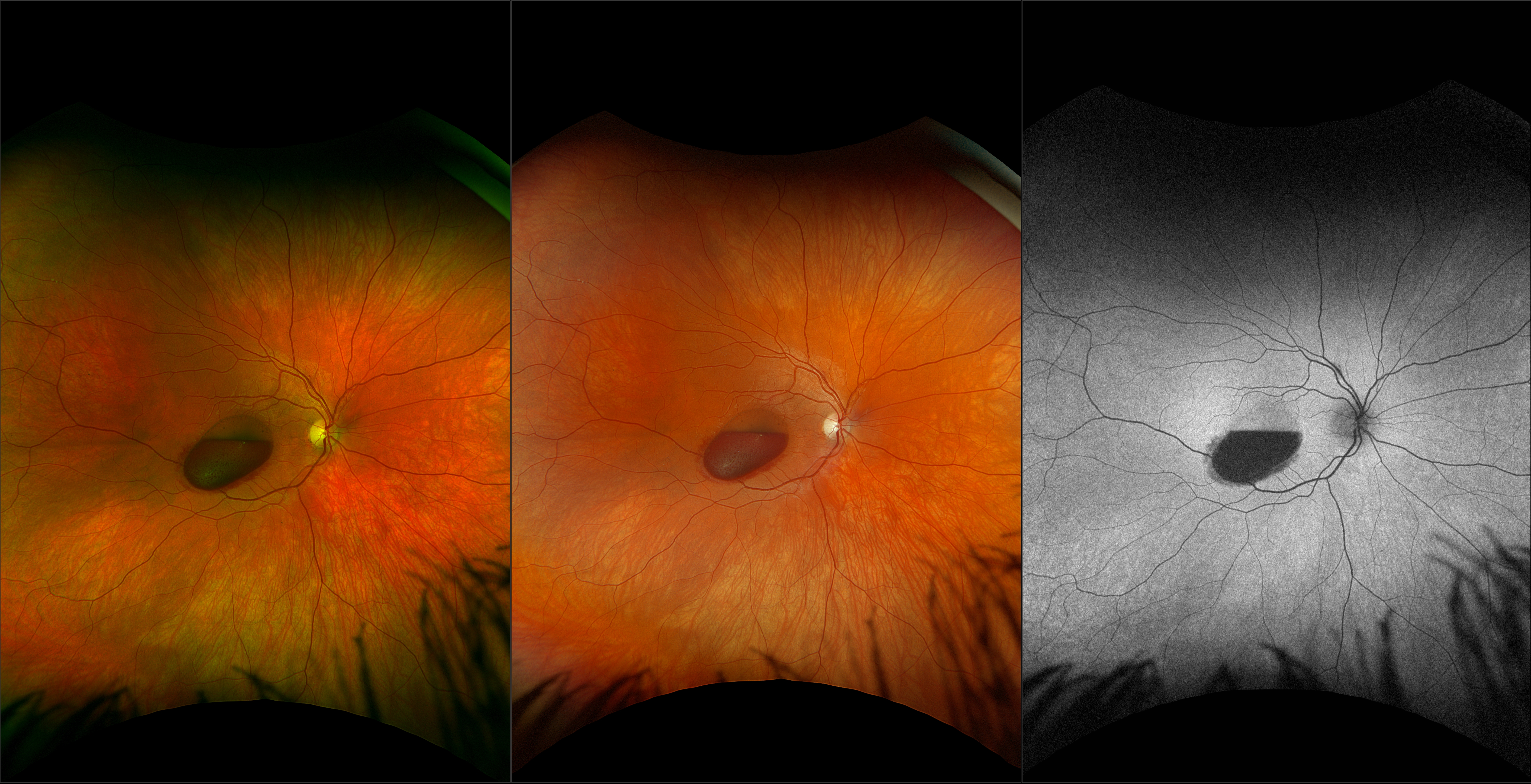 California - Subhyaloid Hemorrhage, RG, RGB, AF