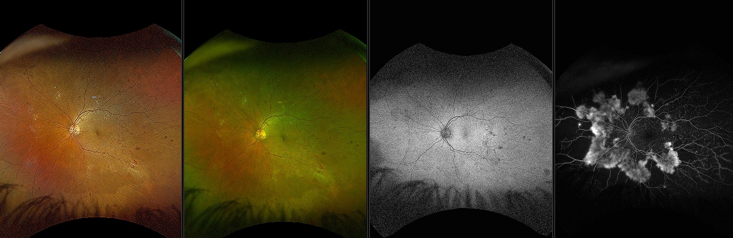 California - Diabetic Retinopathy, RG, RGB, AF, FA