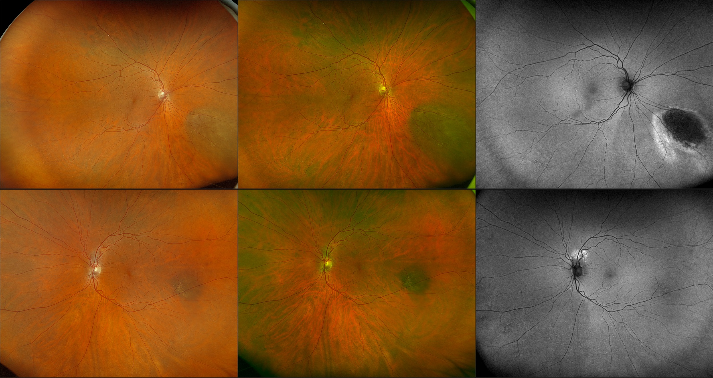 California - Bilateral Peripheral Nevus, RGB, RG, AF