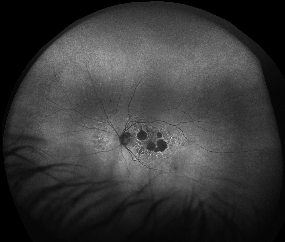 Age-related Macular Degeneration (AMD), AF