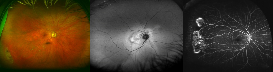 ultra-widefield retinal imaging