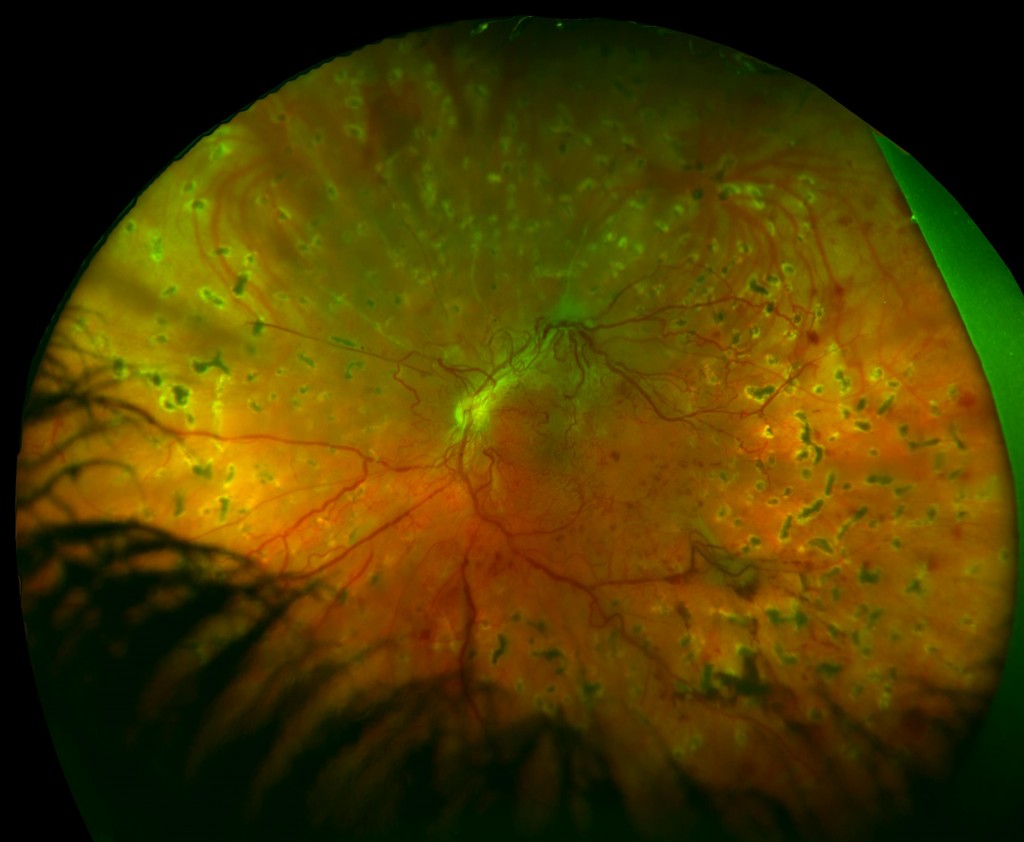 diabetic-retinopathy