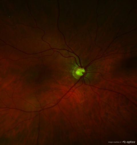 ultra-widefield retinal imaging