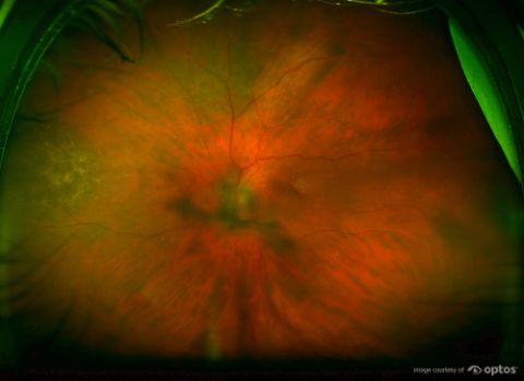 ultra-widefield retinal imaging