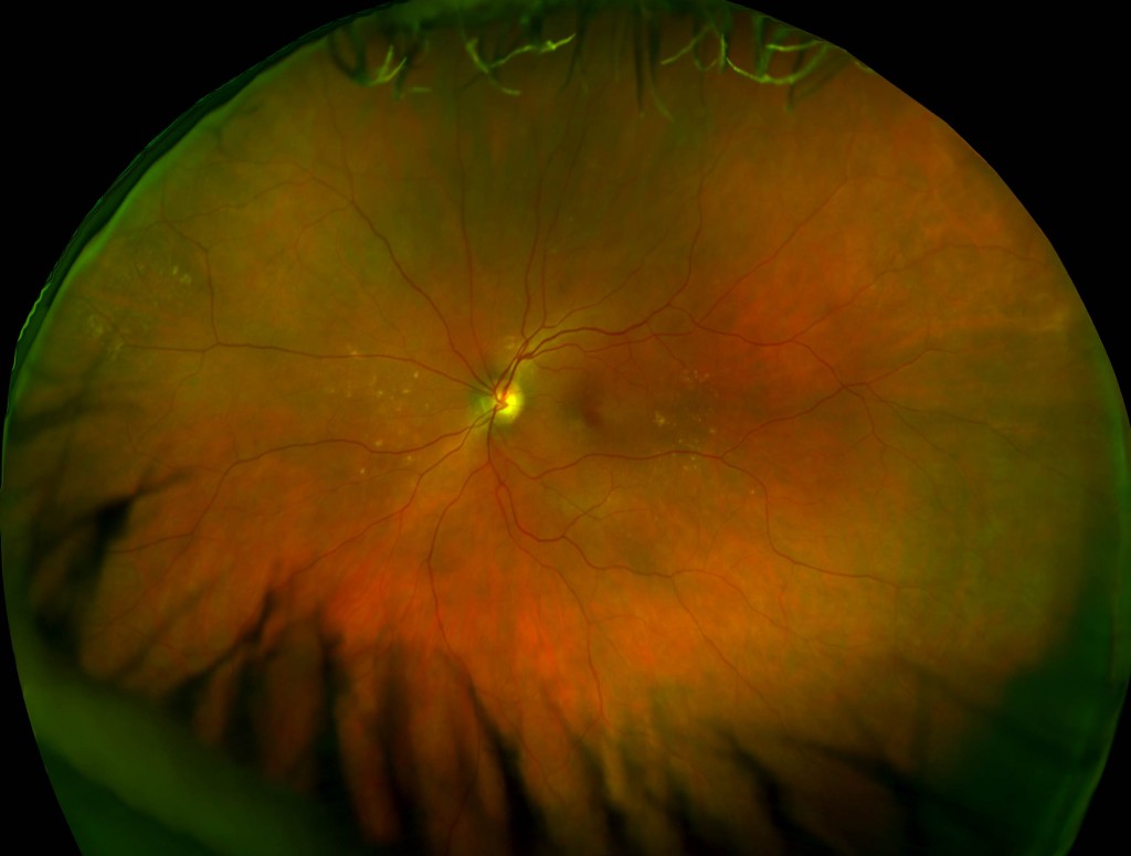 color optomap images with peripheral drusen