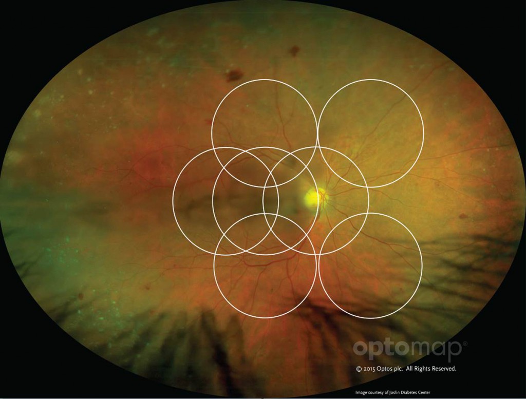 optomap image as compared to ETDRS 7 standard fields.
