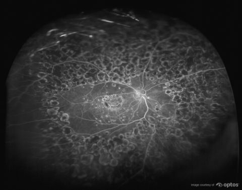 diabetic eye disease