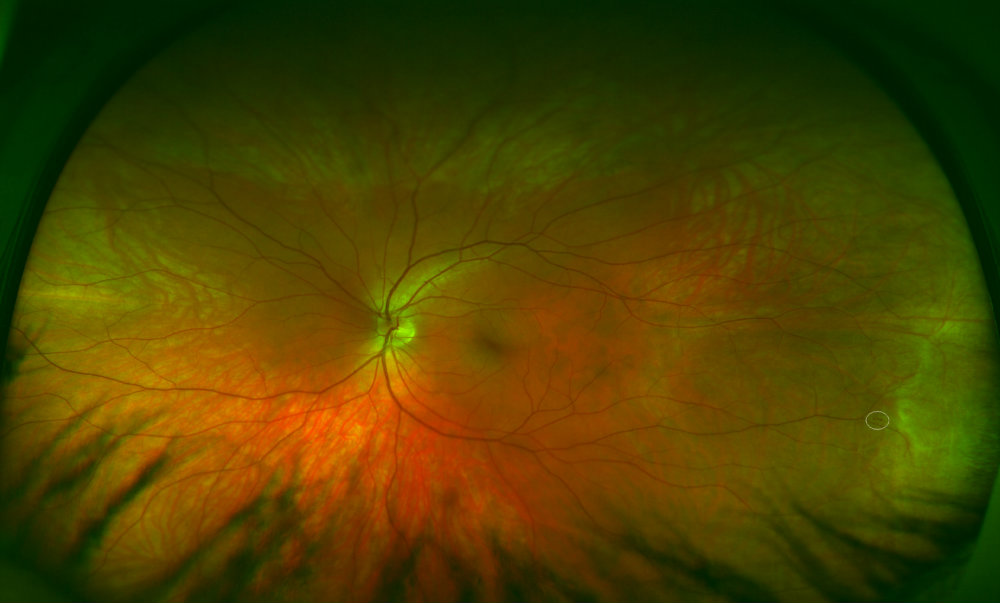 ultra-widefield retinal imaging