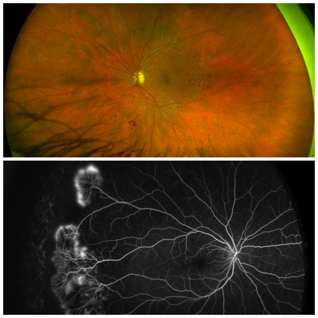 Top: Diabetic Retinopathy, California - Courtesy of Paulo Stanga, MD. Bottom: Retinopathy of Prematurity, Daytona, Proviewed