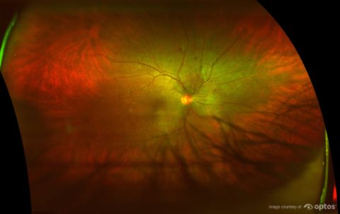 diabetic retinopathy