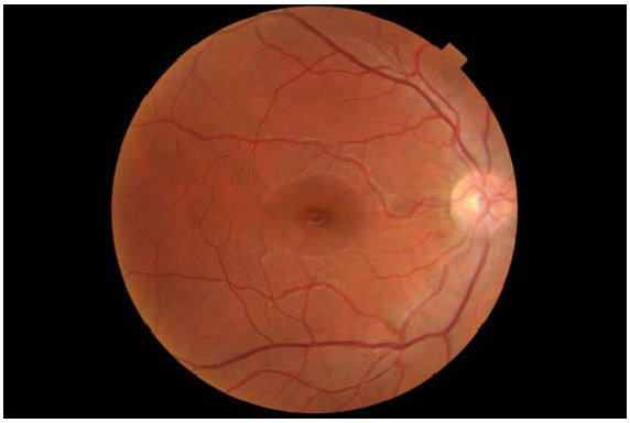 retinal toxicity