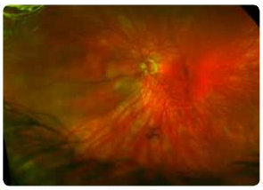 Rhegamtogenous Retinal Detachment