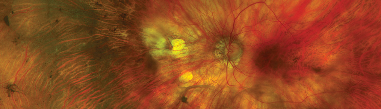 color rg with cataract