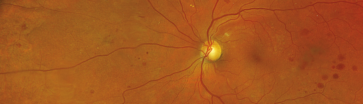 color rgb image with Diabetic Retinopathy 