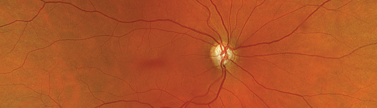 Color rgb with Glaucoma