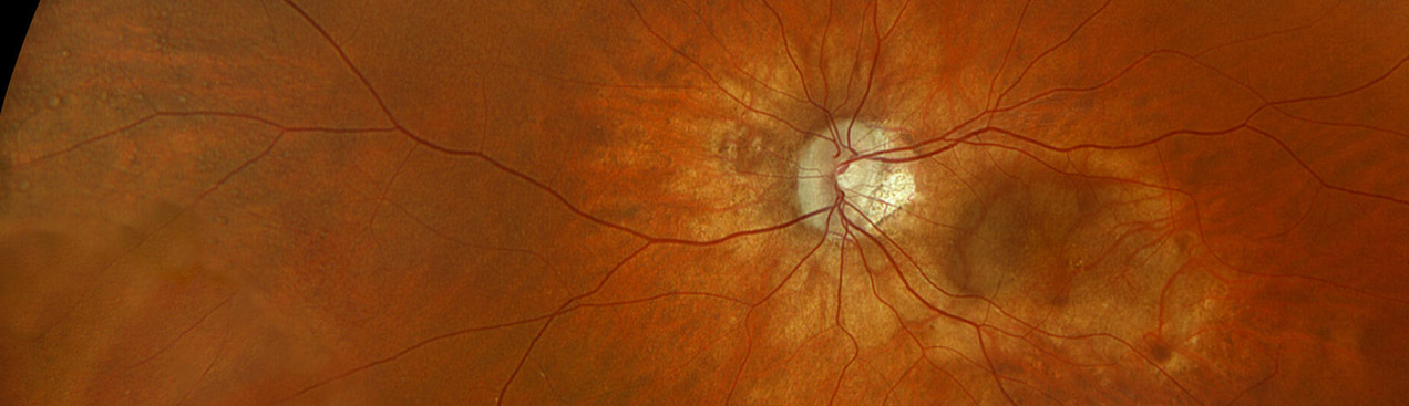 Color rgb with Myopia