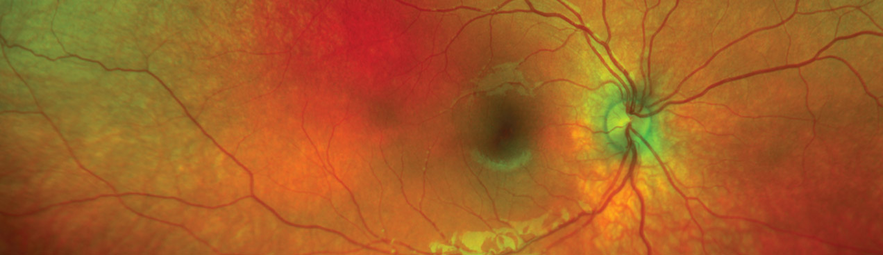 Color rg with Retinopathy of Prematurity