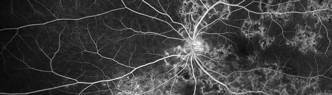 FA image with Uveitis