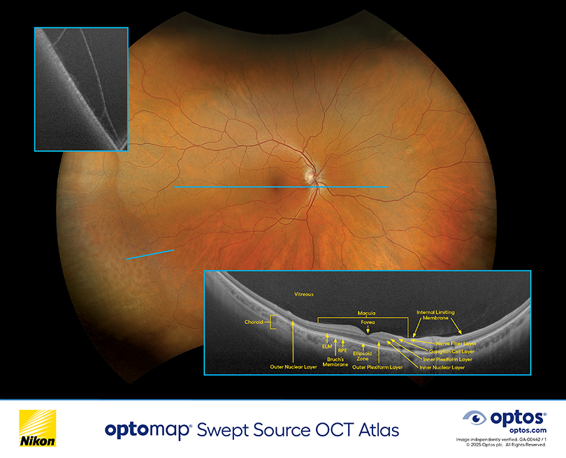 Diagnostic Atlas - optomap icg