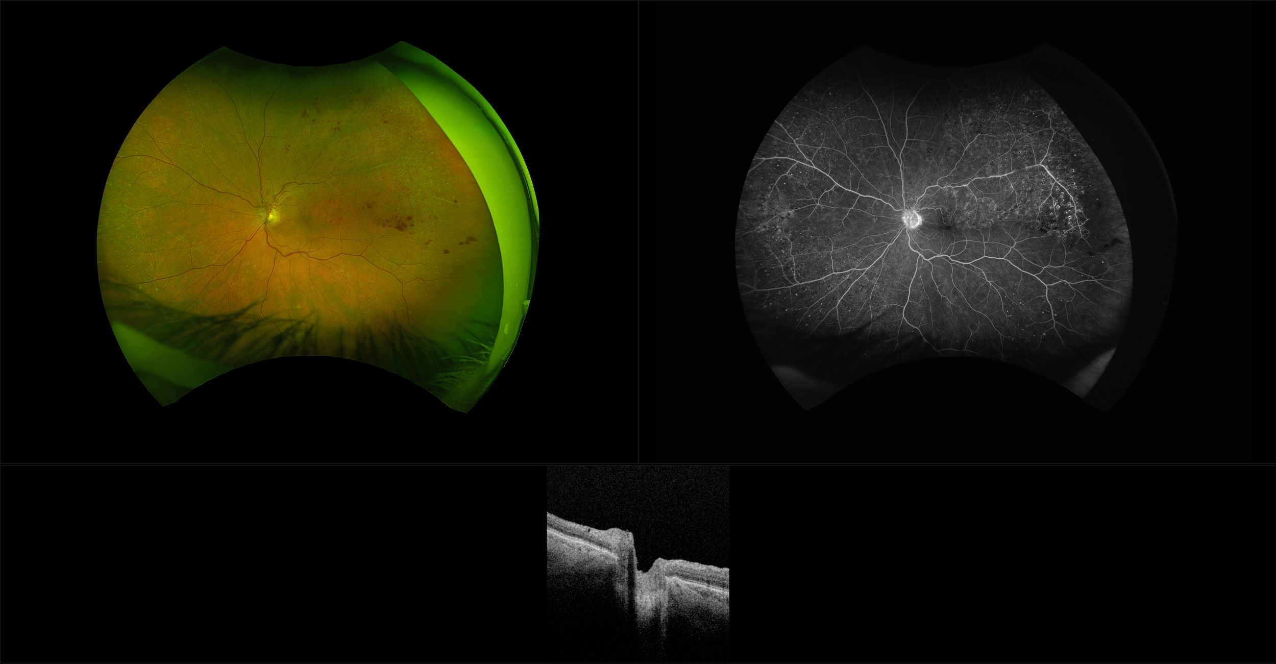 Silverstone - Retinal Vein Occlusion, RG, FA, OCT