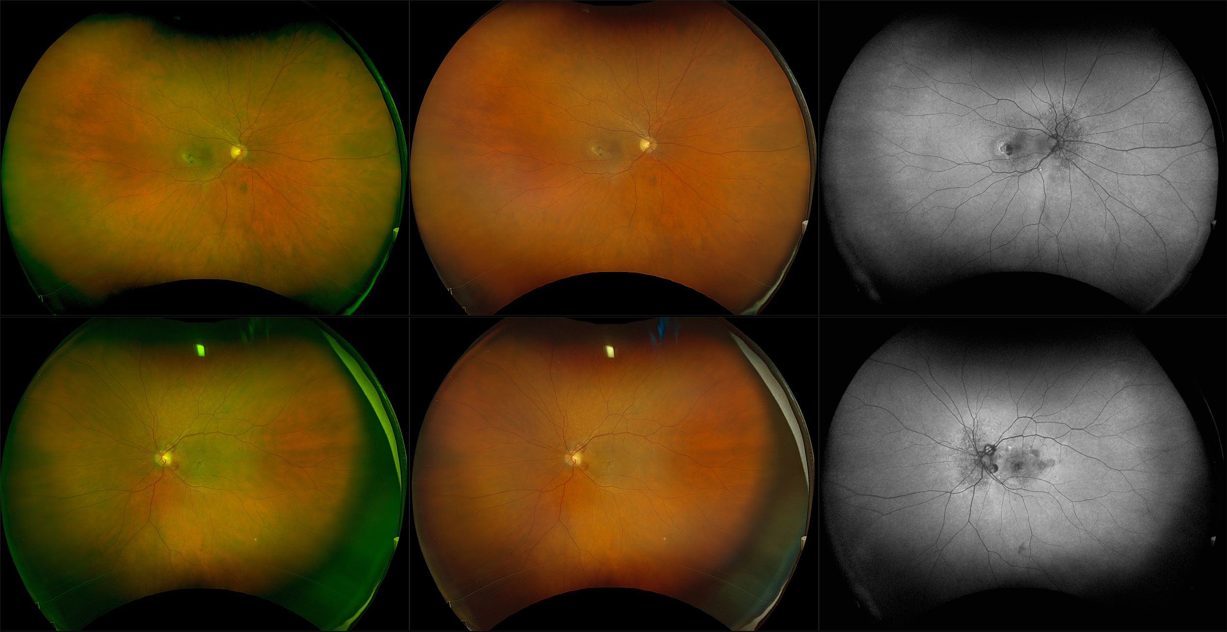 California - Neovascular AMD with Inactive CNV, RG, RGB, AF