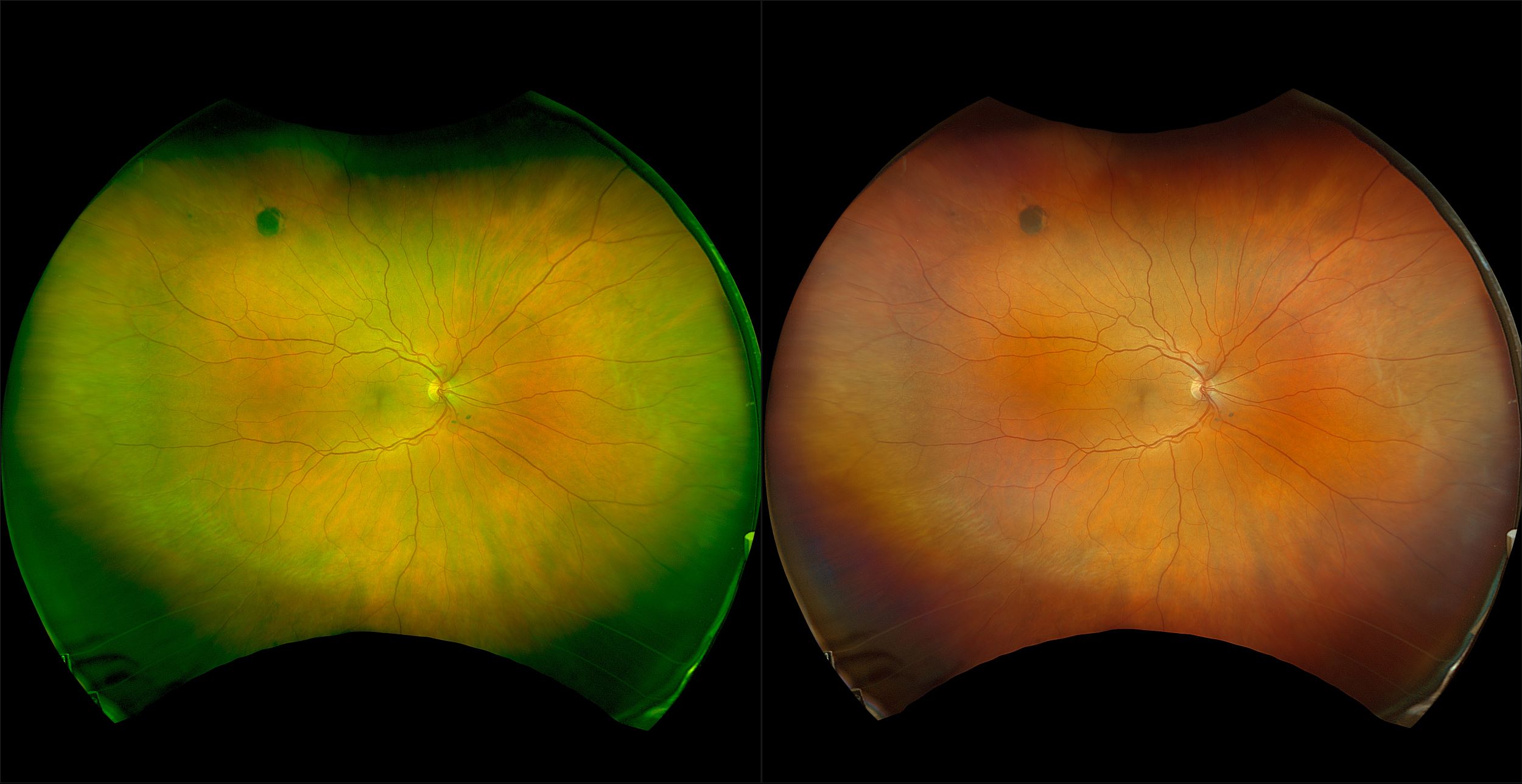 California - Congenital Hypertrophy of the RPE with Macular Drusen, RG, RGB