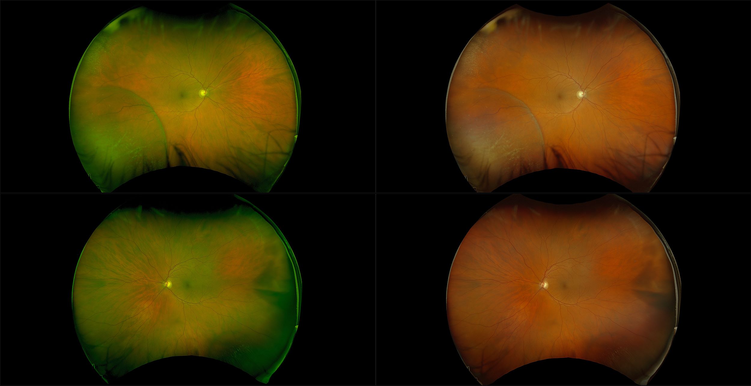 California - Retinoschisis, RG, RGB