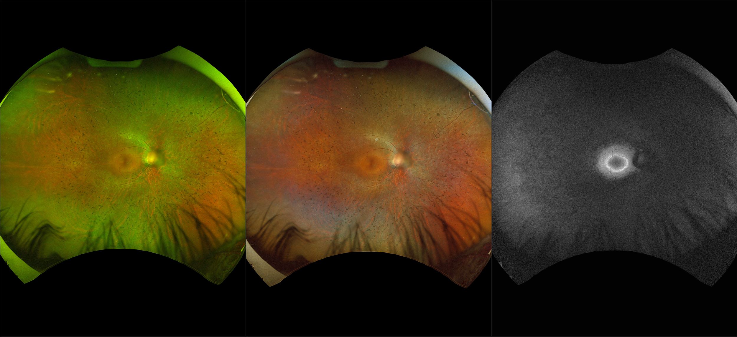 California - Retinitis Pigmentosa, RG, RGB, AF