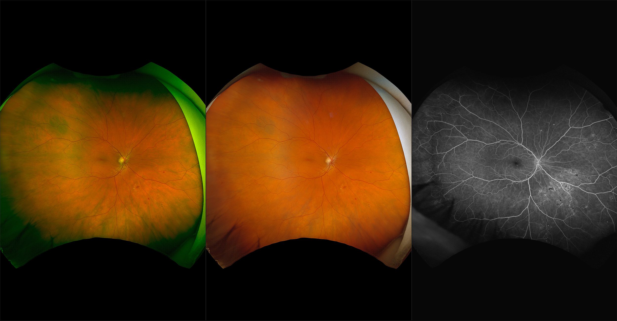 California - Nonproliferative Diabetic Retinopathy, RG, RGB, FA