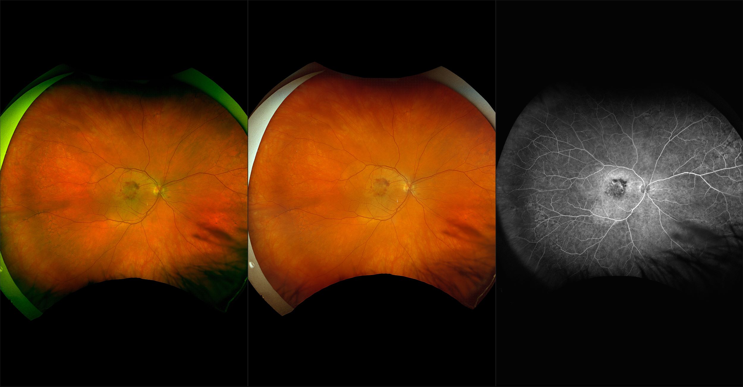 California - Neovascular AMD, RG, RGB, AF, FA