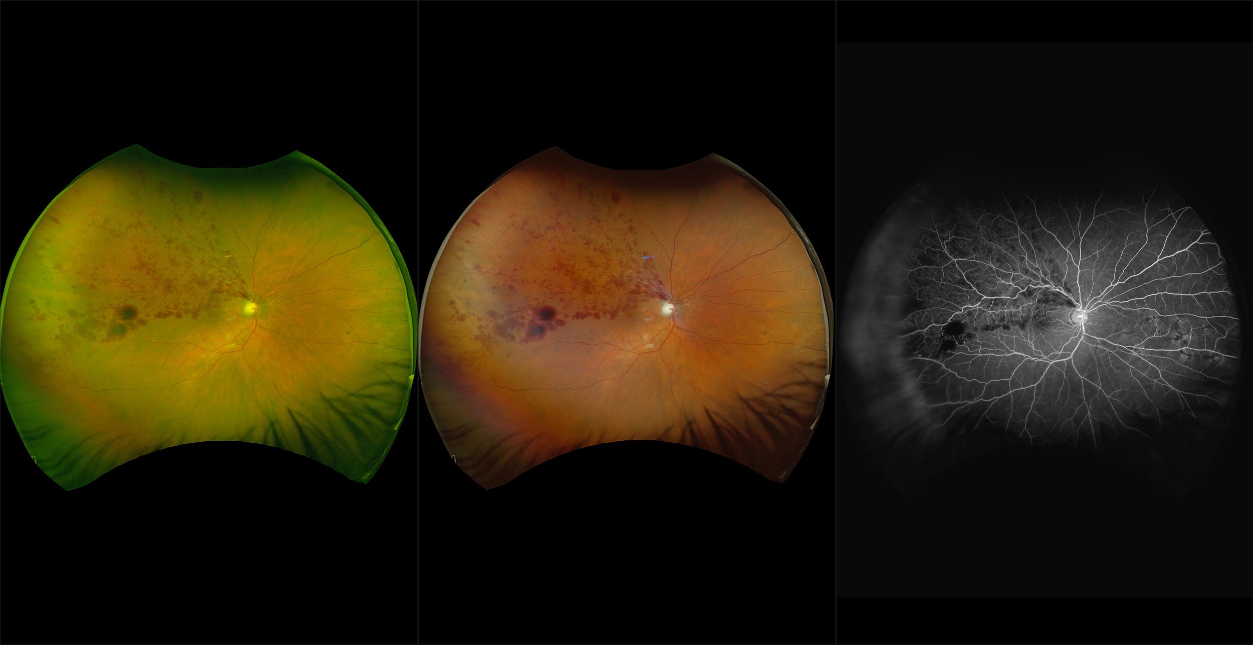 California - BRVO with Macular Edema, RG, RGB, FA