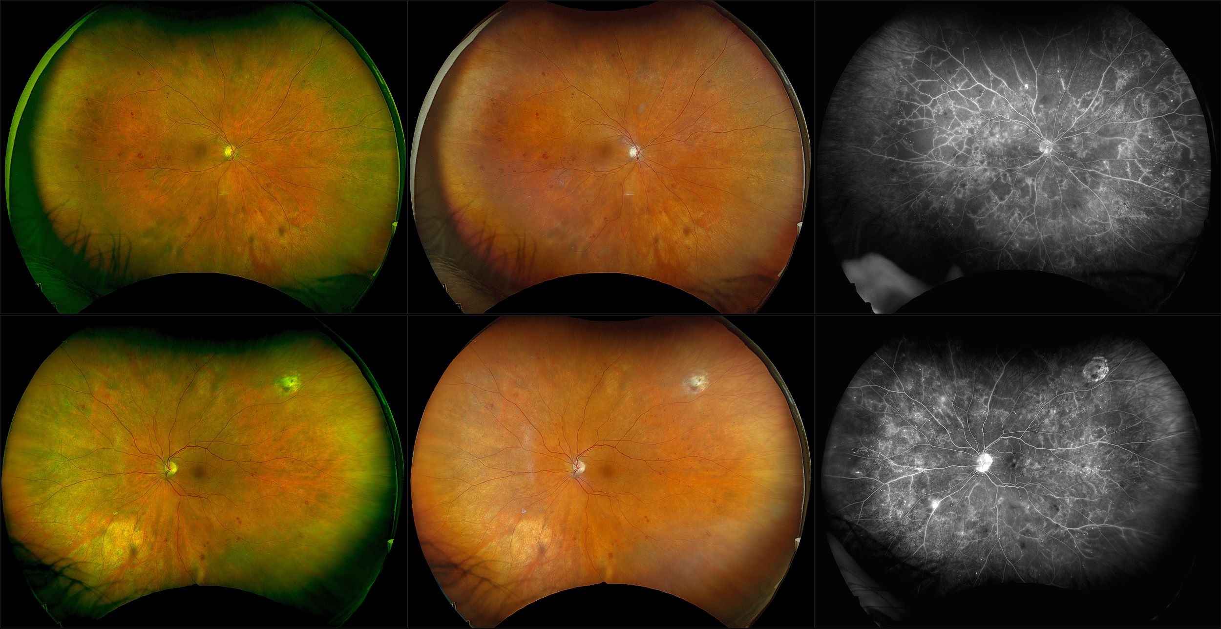 California - Proliferative Diabetic Retinopathy, RG, RGB, FA