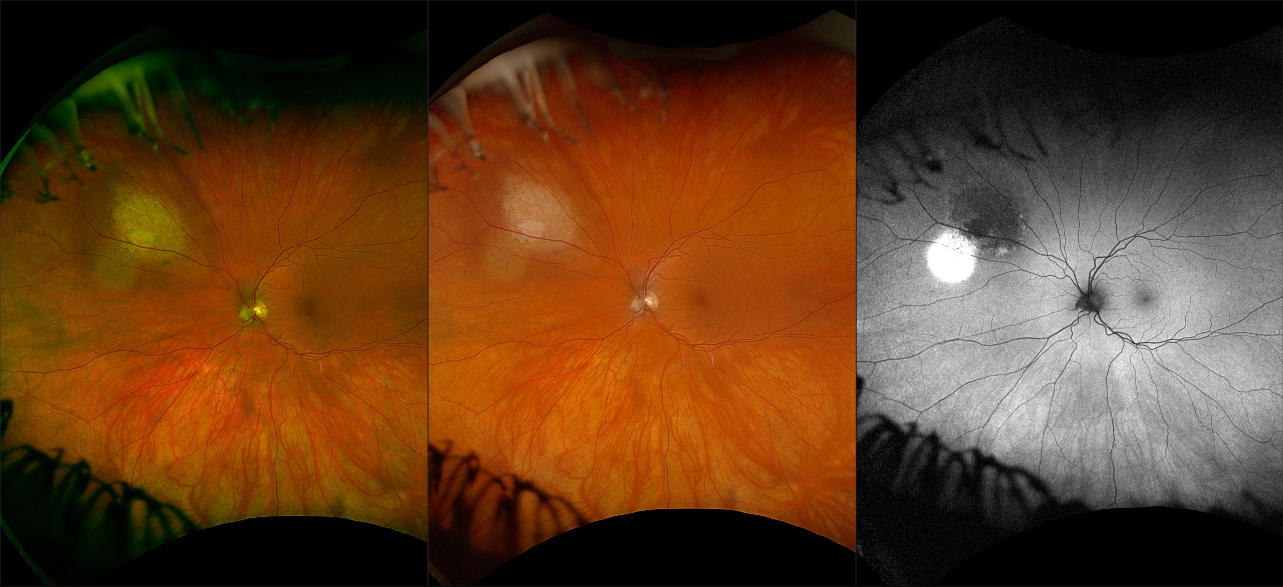 California - Choroidal Nevus, RG, RGB, AF