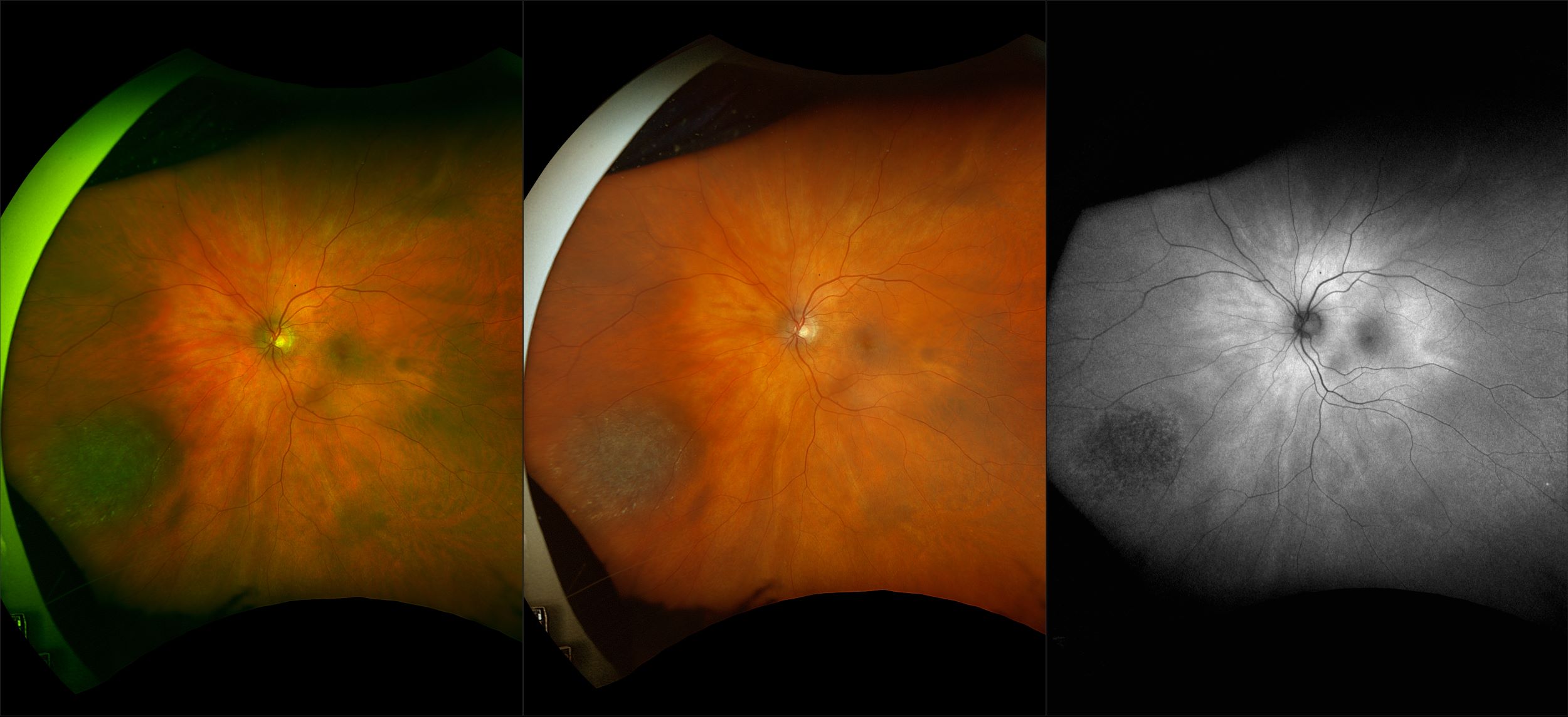 California - Choroidal Nevus, RG, RGB, AF