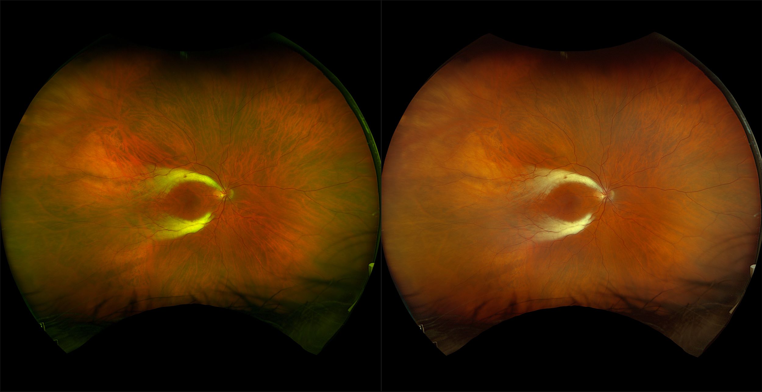 California - Myelinated Nerve Fiber Layer, RG, RGB