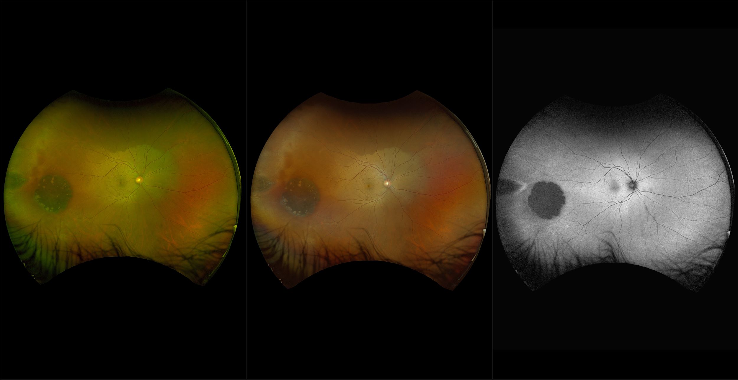 California - Large Choroidal Nevus, RG, RGB, AF