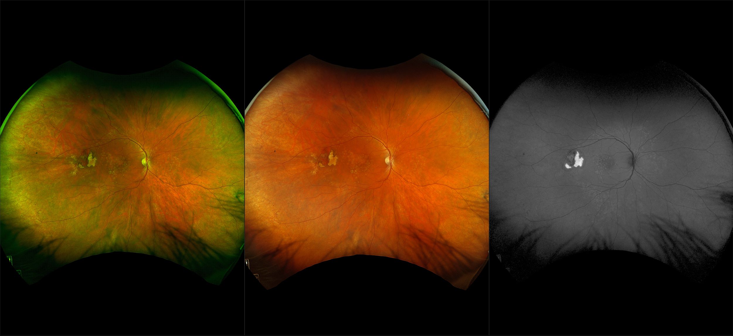 California - Intraretinal Hemorrhage, RG, RGB, AF