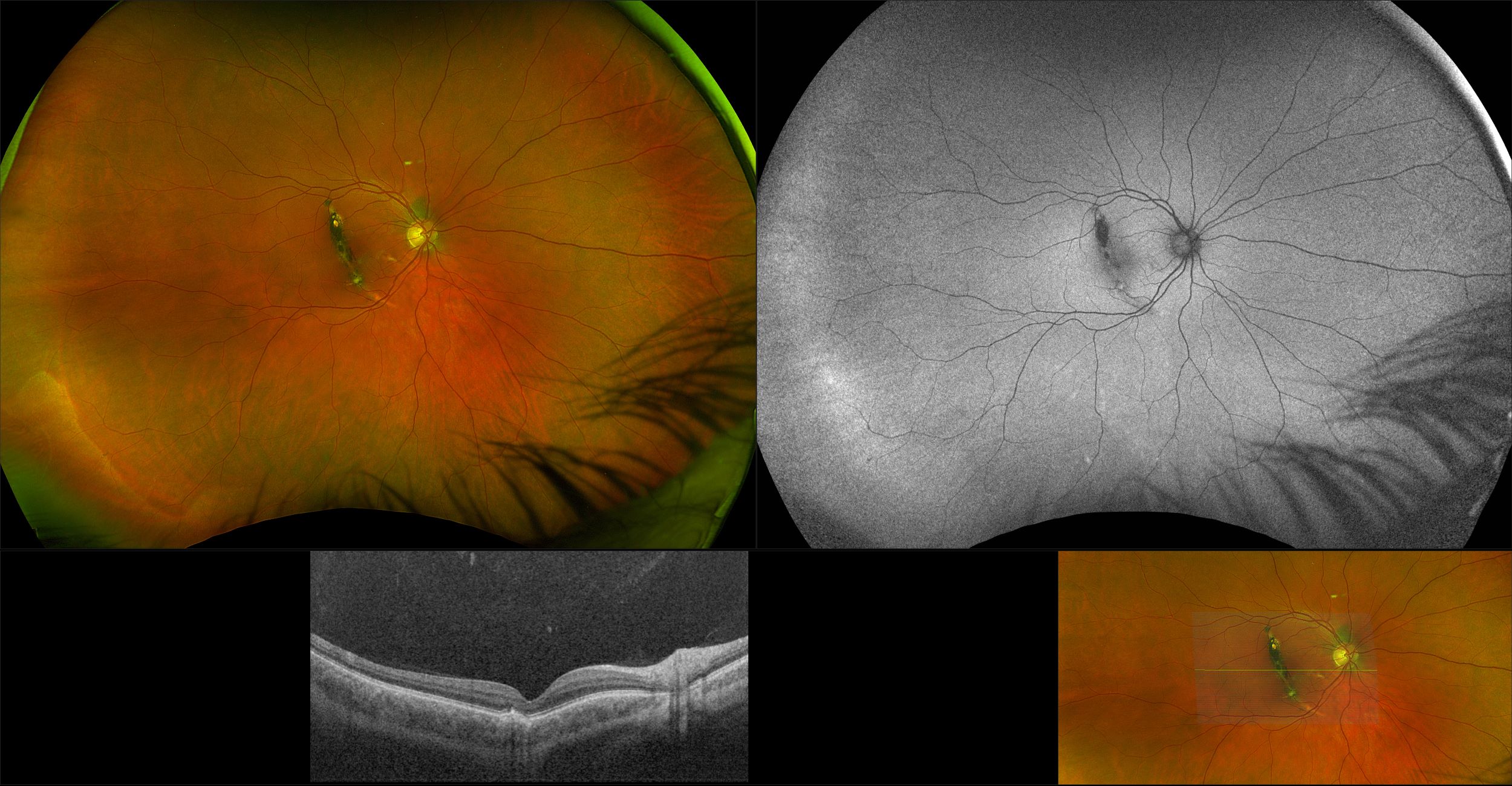 Silverstone - Traumatic Choroidal Rupture, RG, AF, OCT