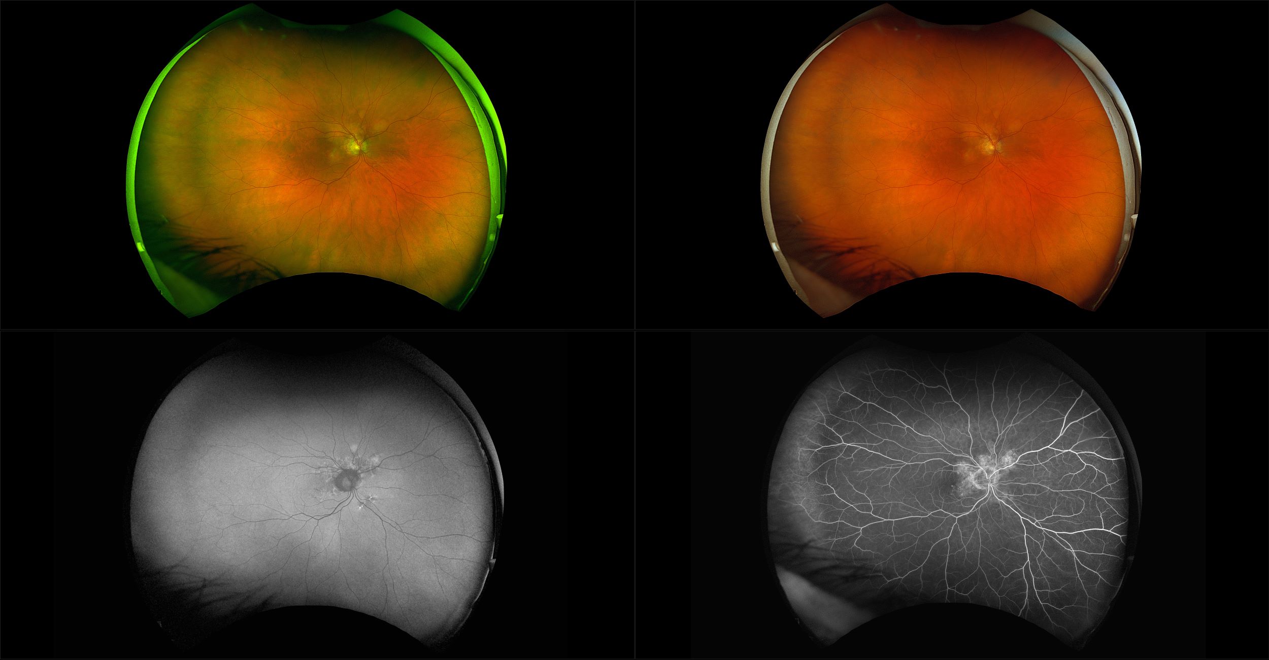 California - Neovascular AMD, RG, RGB, AF, FA