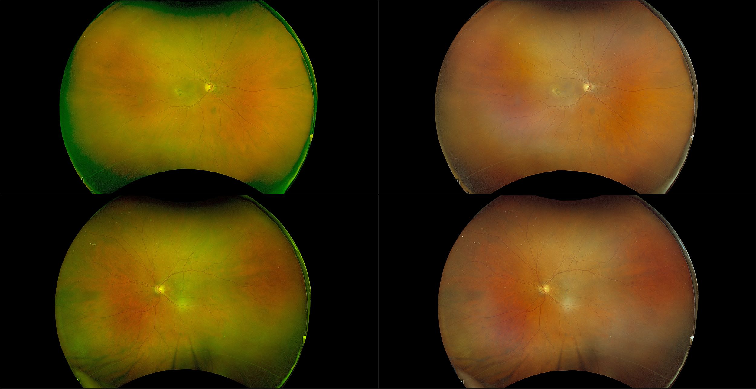 California - Neovascular AMD with Inactive CNV, RG, RGB