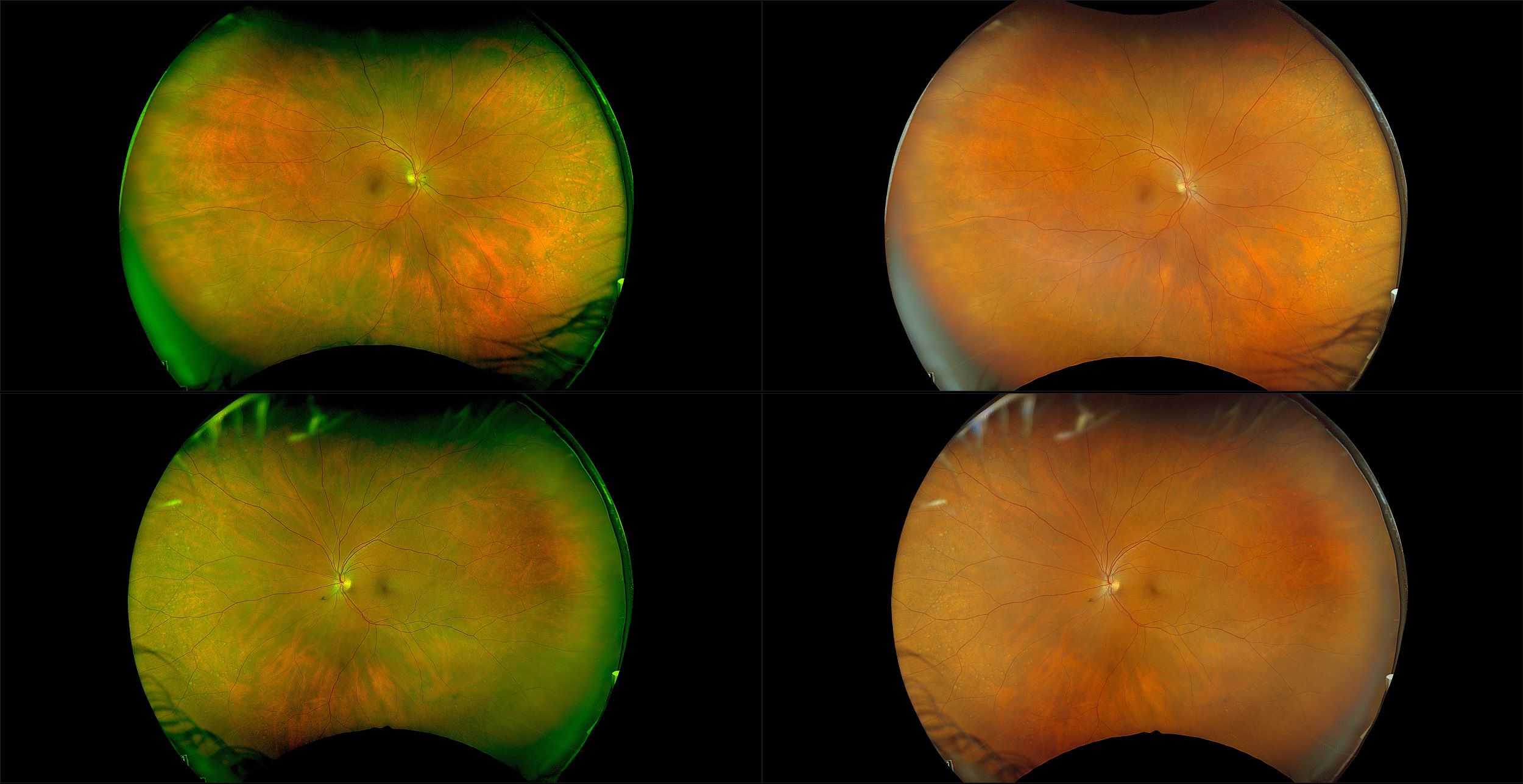 California - Peripheral Drusen with Long Term Plaquenil Monitoring, RG, RGB