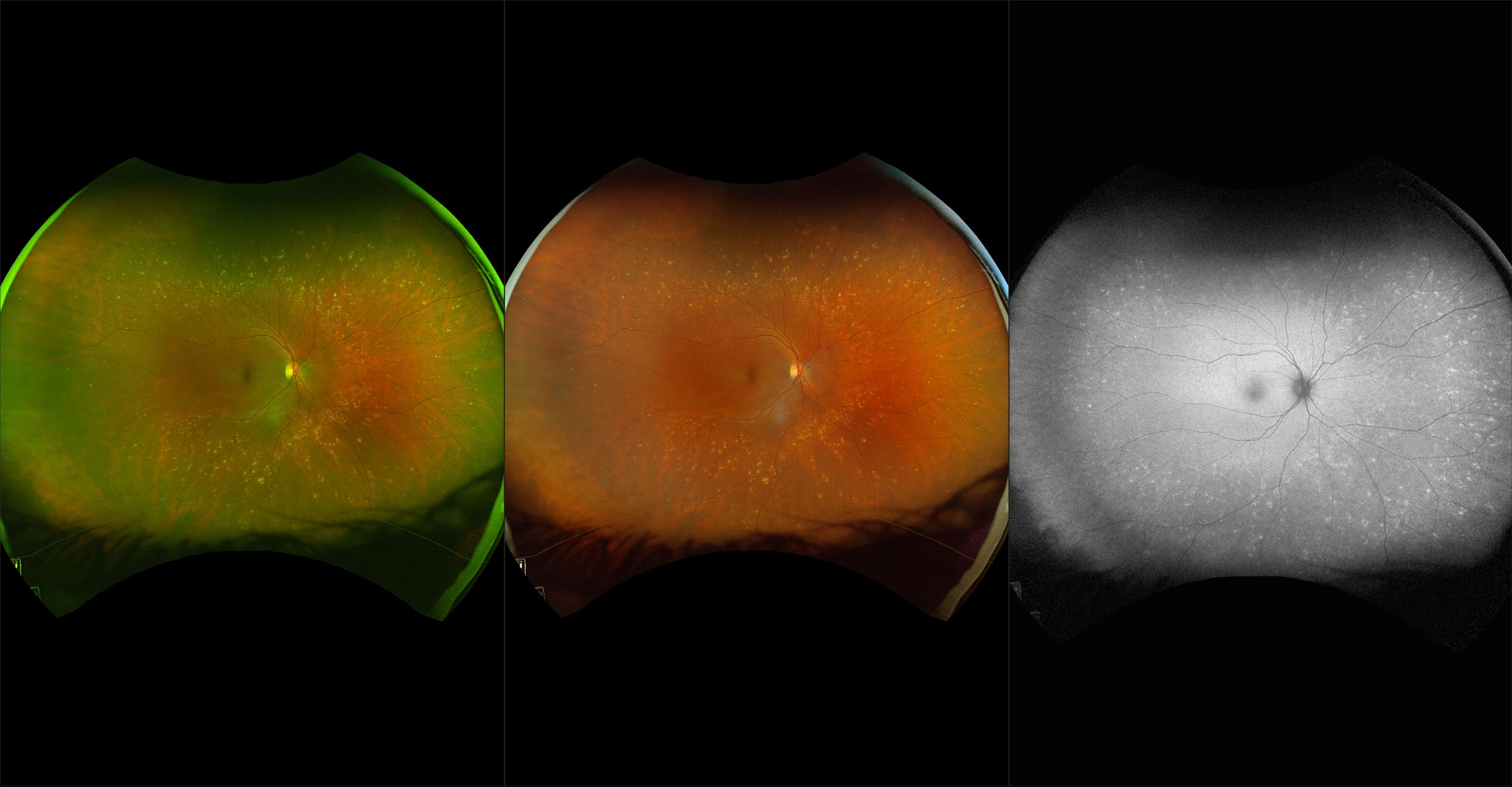 California - Peripheral Drusen, RG, RGB, AF