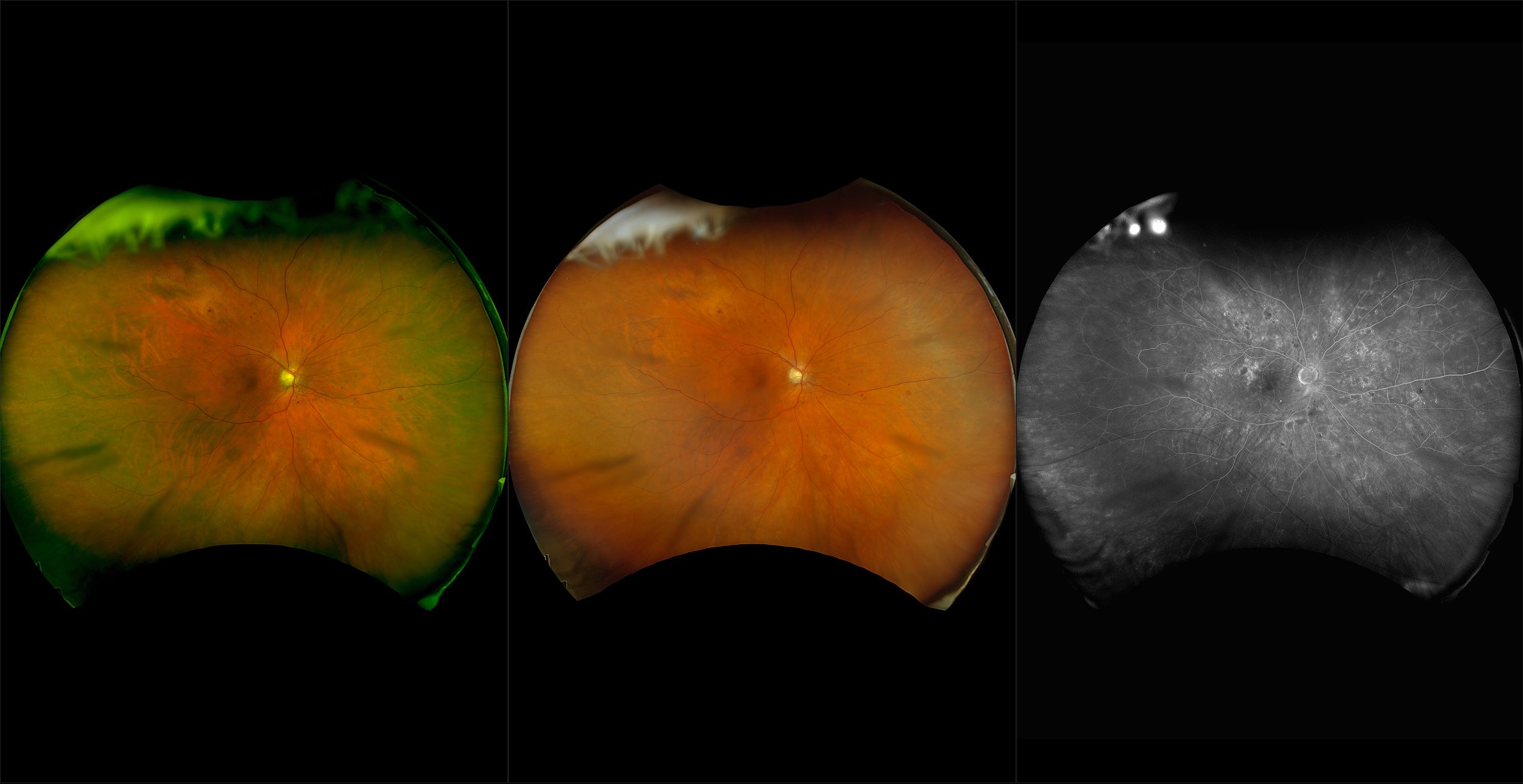 California - Nonproliferative Diabetic Retinopathy Severe, RG, RGB, FA