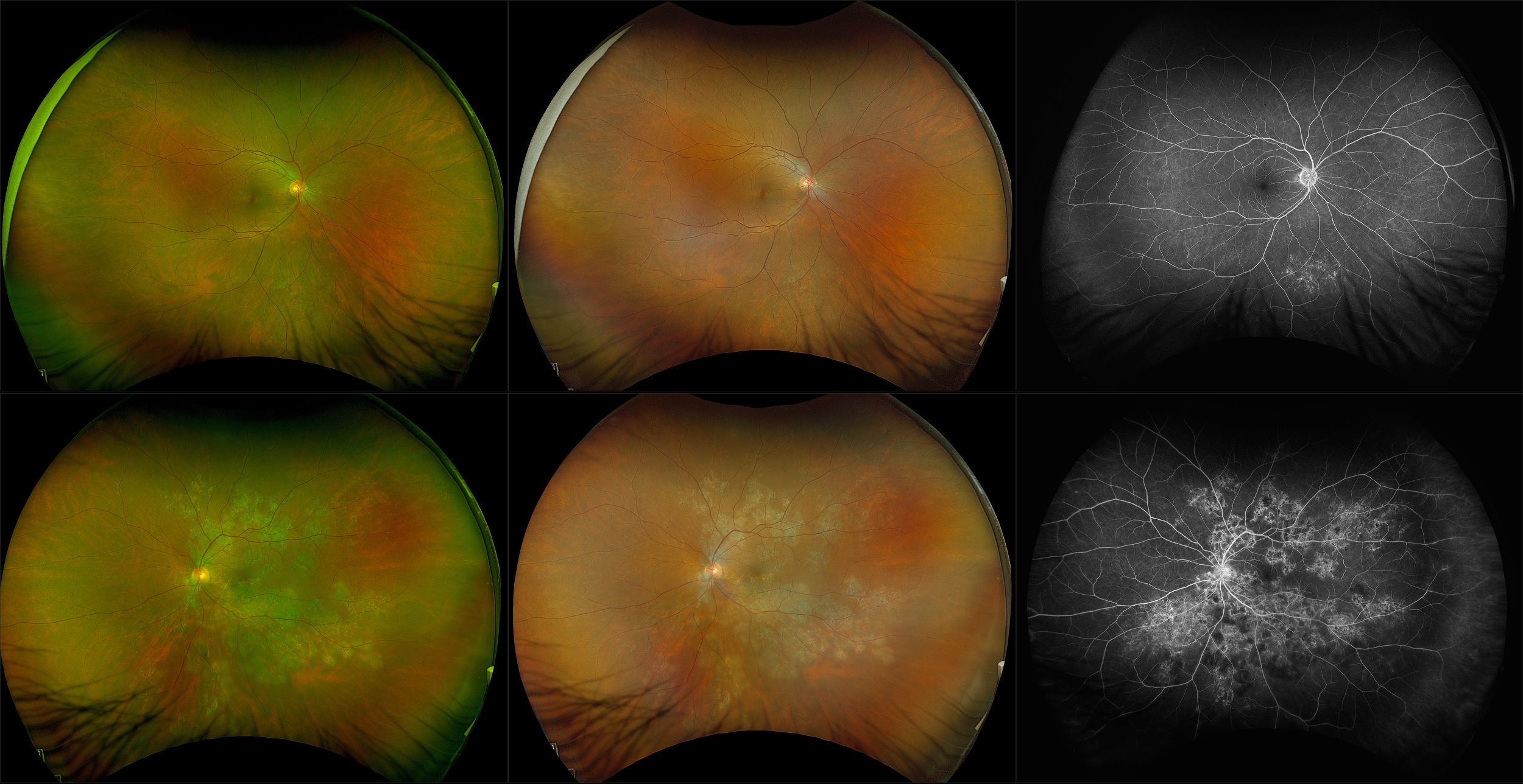 California - Disseminated Chorioretinitis with Macular Drusen, RG, RGB, FA