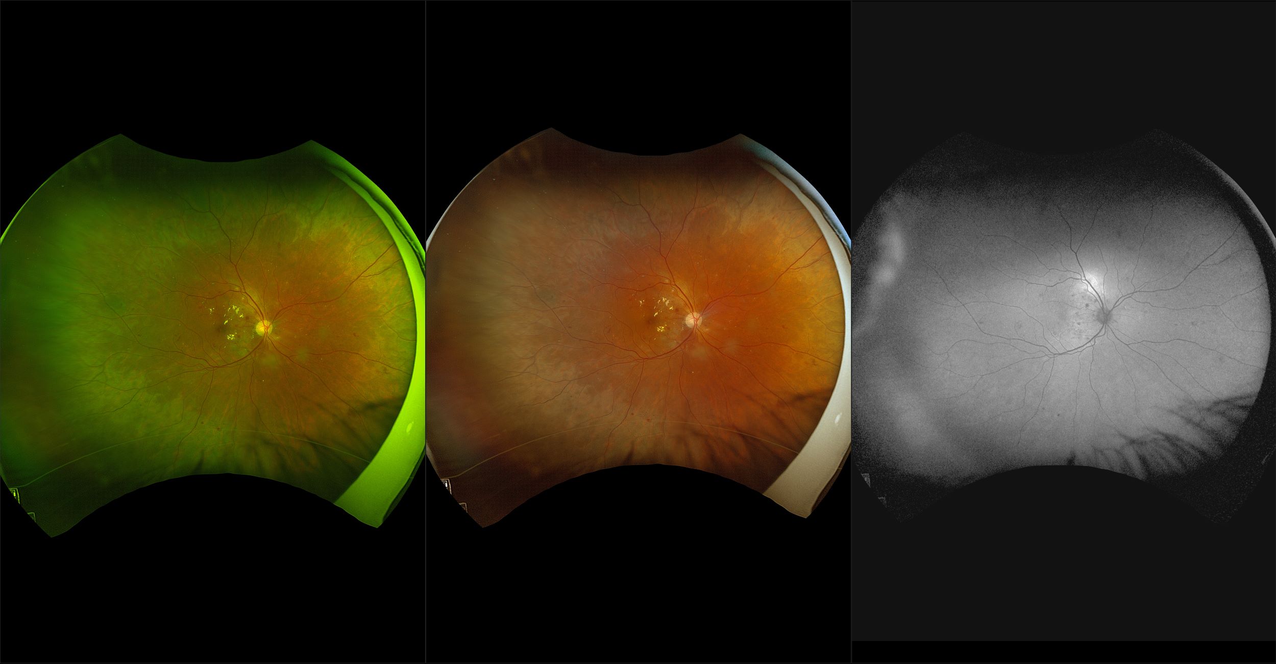 California - Diabetic Retinopathy, RG, RGB, AF