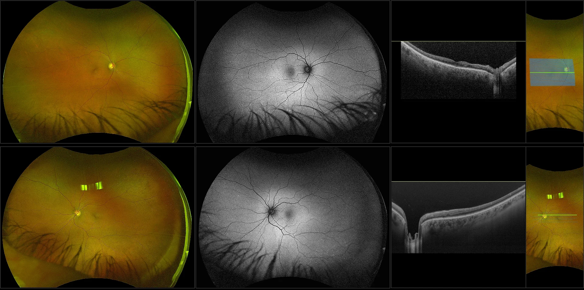 Silverstone - Primary Open-Angle Glaucoma, Mild, RG, AF, OCT