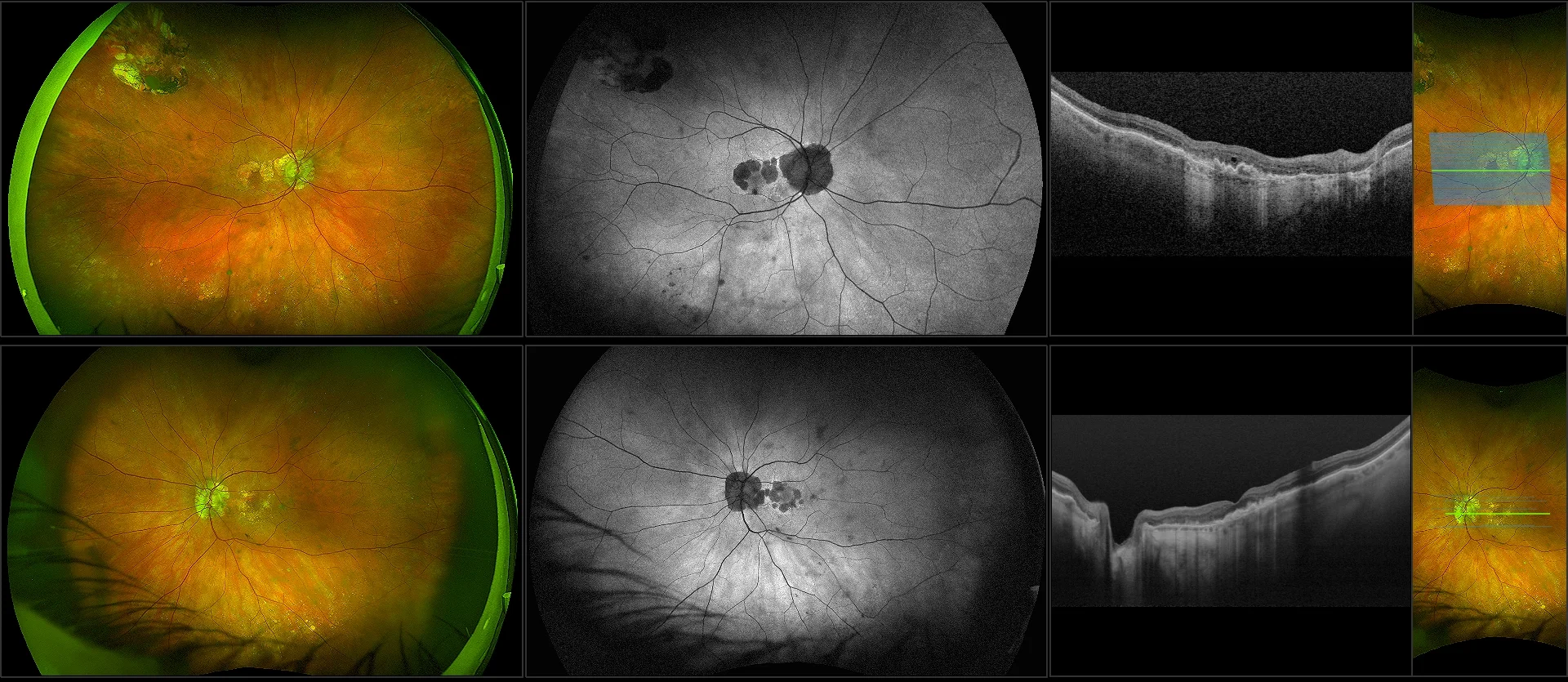 Silverstone - Wet AMD with Active Neovascularization, RG, AF, OCT