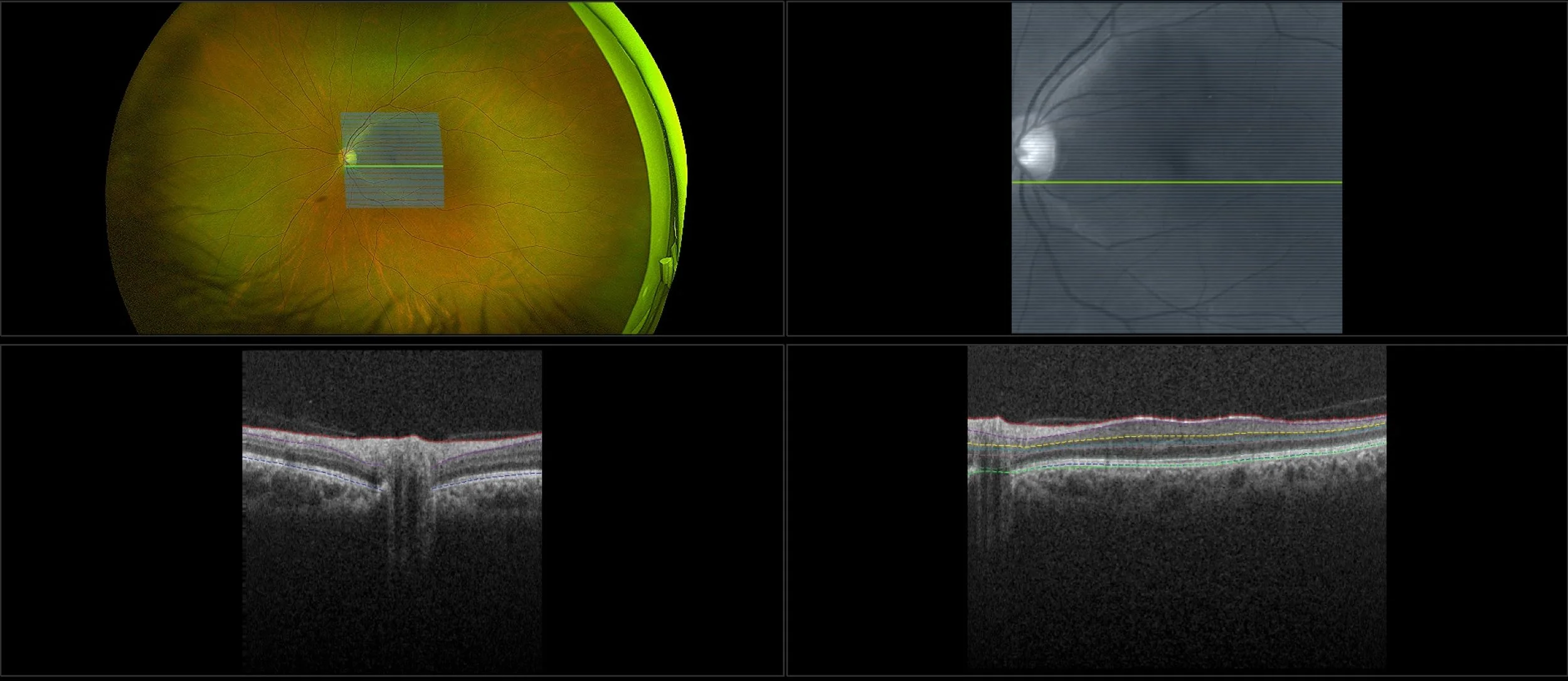 MonacoPro - Epiretinal Membrane, RG, OCT