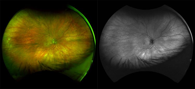 Silverstone - Wet AMD with Sub Retinal Fluid - Full Steer - RG, AF